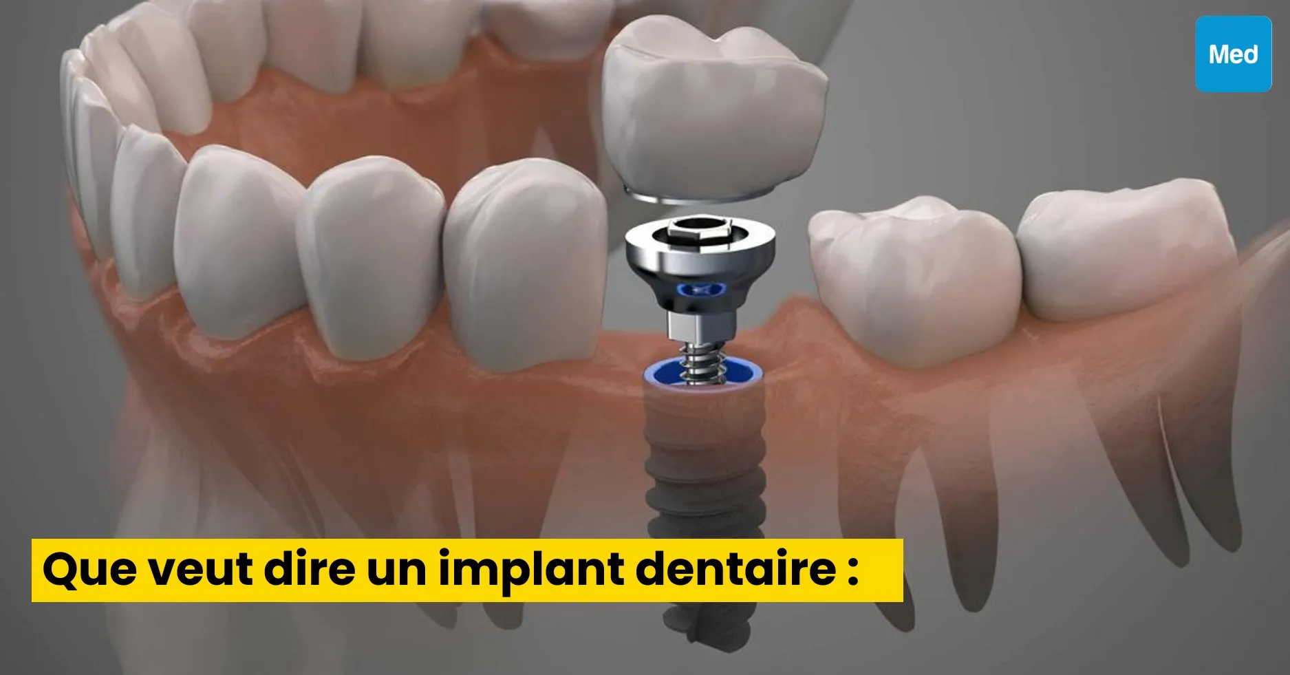 Que veut dire un implant dentaire